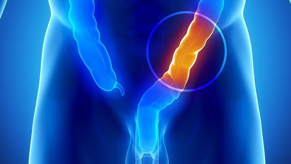 Médico chama atenção para necessidade da prevenção do câncer de intestino