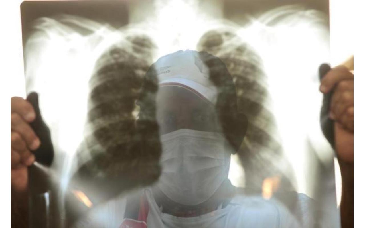 24 de Março: Hoje é o Dia Internacional da Tuberculose
