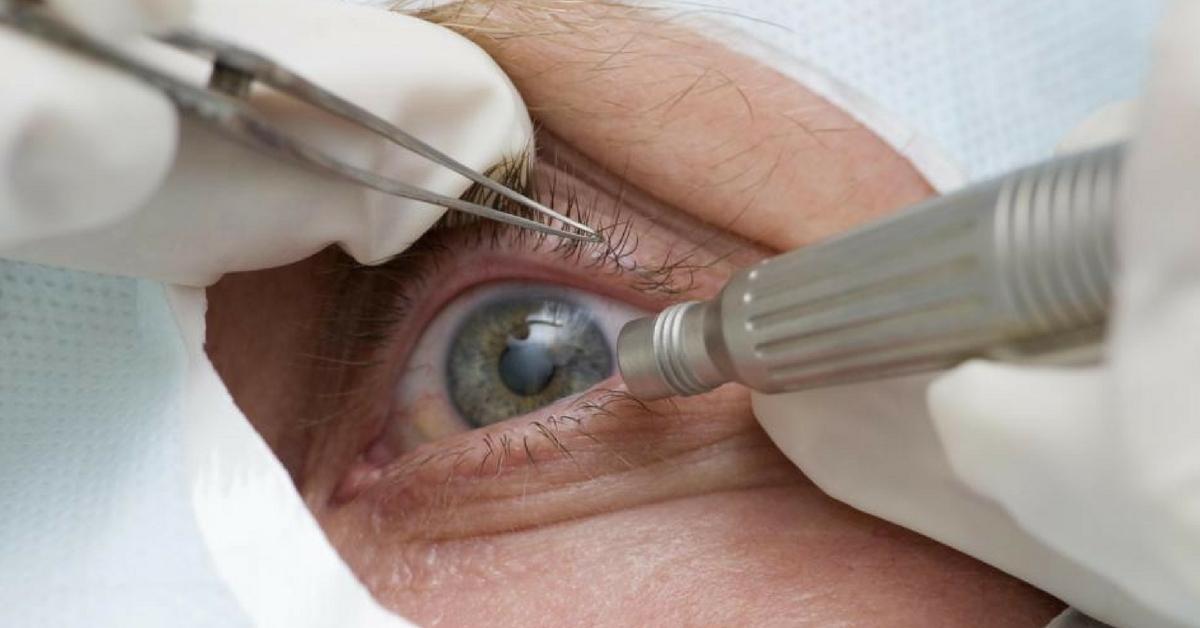Cerca de 1.200 pessoas do Alto Vale serão beneficiadas com mutirão de cirurgias de catarata