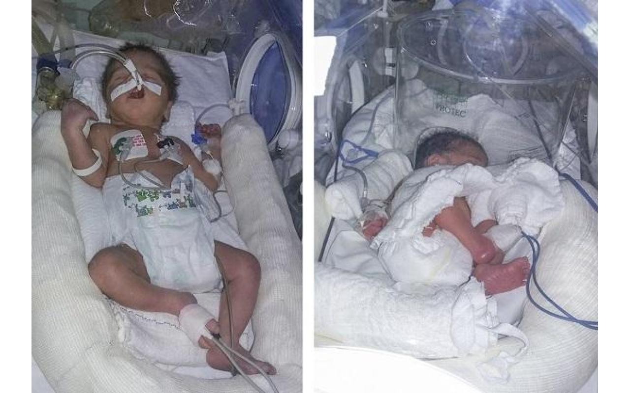 Gêmeos prematuros precisam de doações em Ituporanga