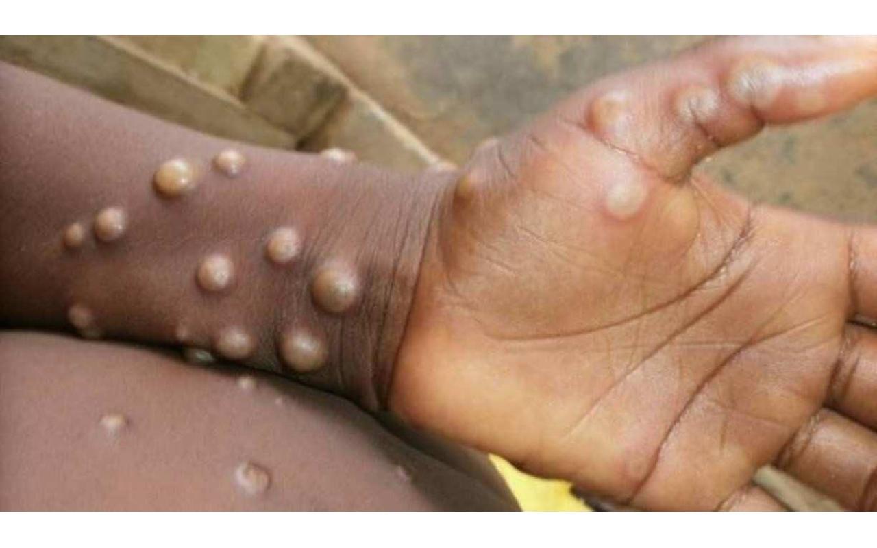SC atinge 21 casos confirmados de varíola dos macacos